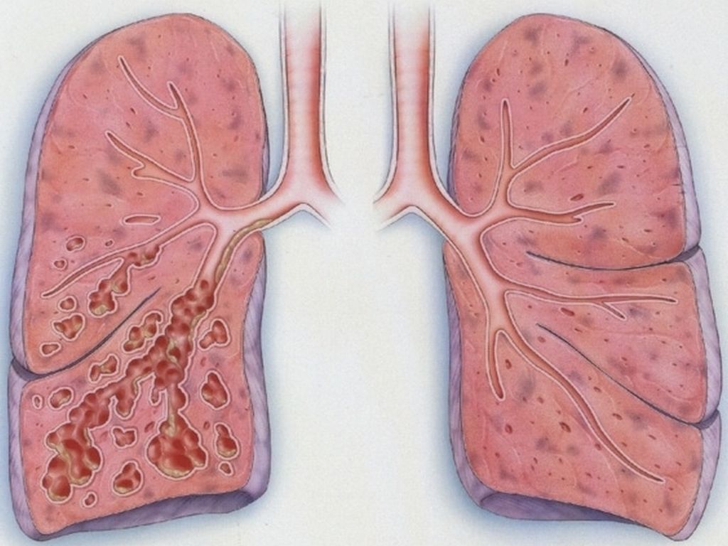 Бронхоэктатическая болезнь рисунки