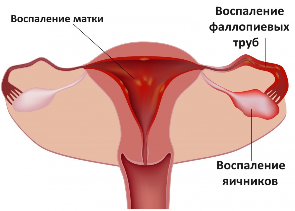 Как вылечить воспаление половых органов в домашних условиях thumbnail